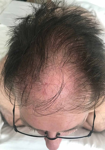 Telogen Effluvium Recovery Timeline — And the 90-Day Photo Method That Stops You Quitting Too Early